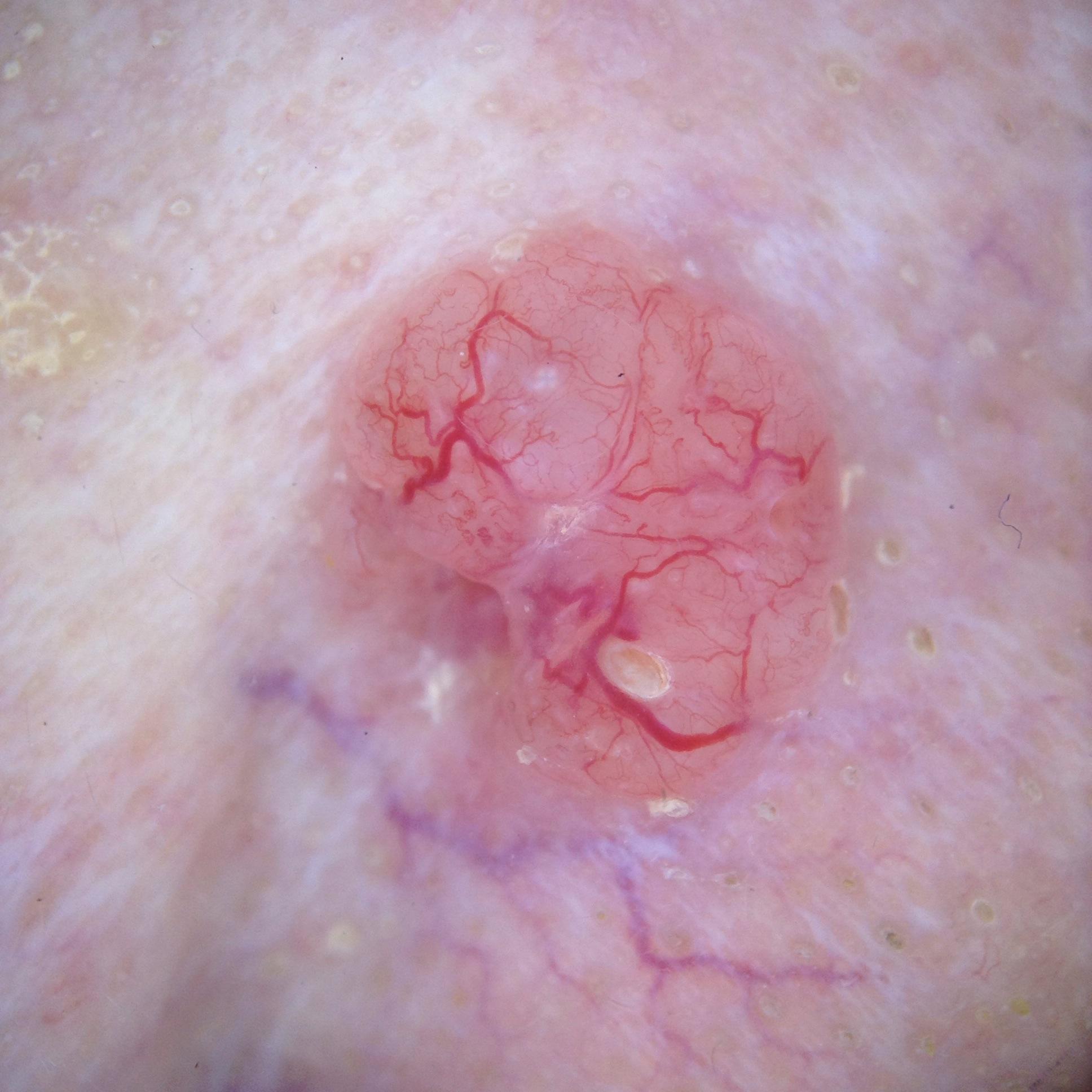 Dermatoscopisch voorbeeldbeeld van een huidafwijking